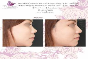 Filler Hidung / Nose Filler